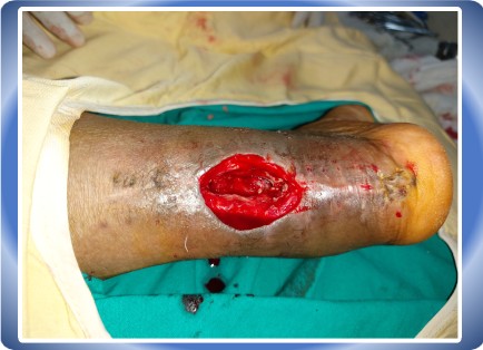 LOWER LIMB INJURY